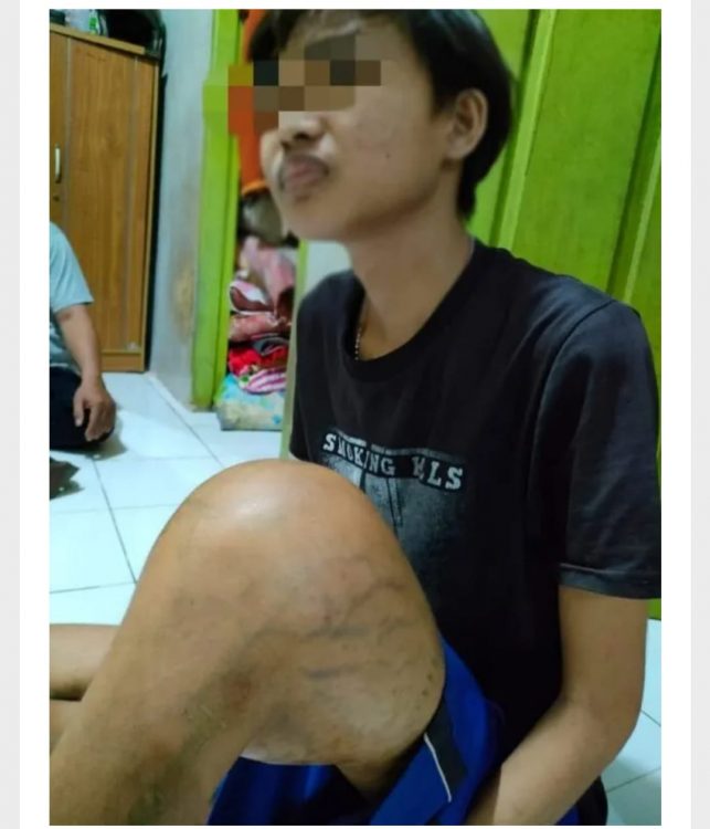 Remaja Penderita Pembengkakan Paha, Berharap ada Bantuan dari Pemerintah